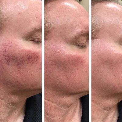 Experiencing spider veins? Vasculaze with Microneedling RF can help you achieve glass skin and more confidence.