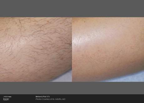 Laser Hair Removal