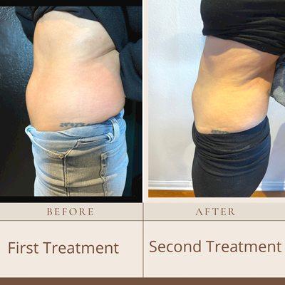 Fat Cavitation+ radio frequency