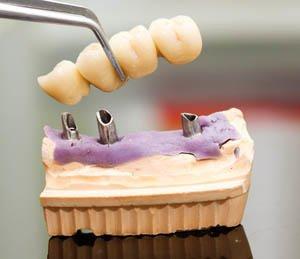 Implant Dentistry Santa Rosa