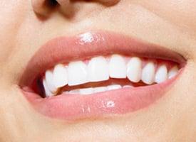 Veneers and Teeth Whitening