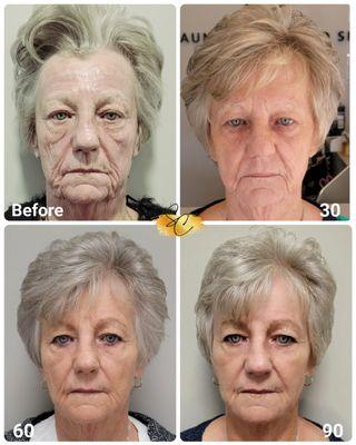 Real Neogen Patient... transformation over 3 months time!  It really works!