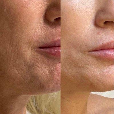 Vivace Microneedling