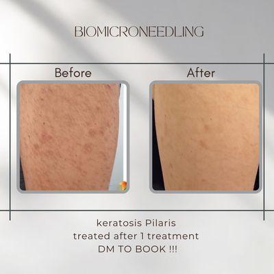 Book your appointment to get clear skin !