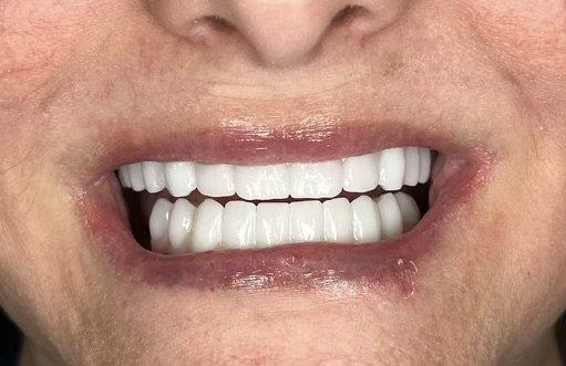 upper /lower fixed zirconia prosthesis, the patient can choose how white and how big they want their teeth to be, this patient wanted white!