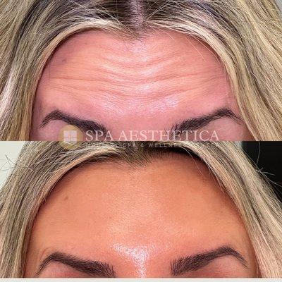 2 Weeks Post Op Botox Before and After Forehead Lines