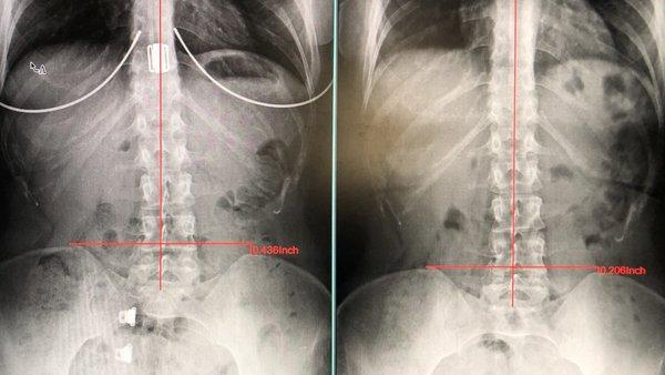 My hips went from a 0.43" tilt to only 0.2" tilt after 3 months of adjustments; and my spine is visibly straighter.