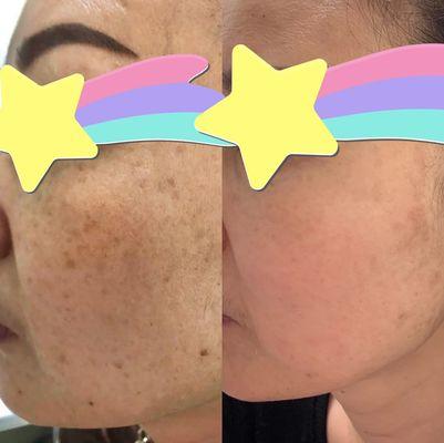 Picoway spot removed treatment 
How to have clear and healthy skin ? 
Candela Picoway