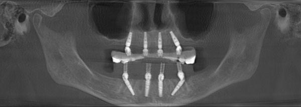 Post-op xrays of patient JP.  Upper and Lower All-on-4 surgery.  Patient was happy with the results.