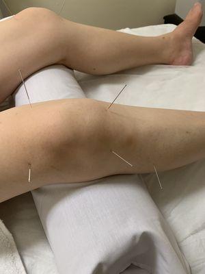 Acupuncture treatment for both side knee pain.