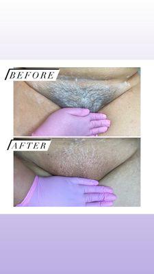 Brazilian wax