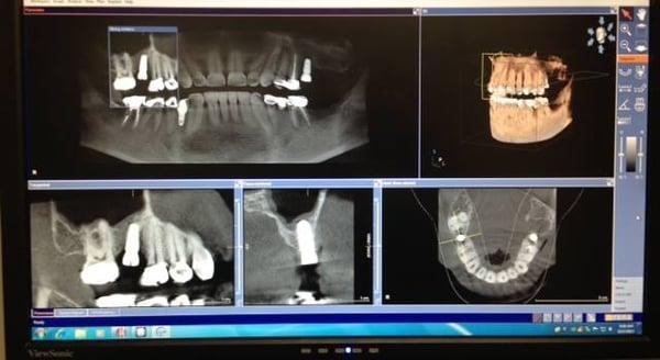 Our 3D Cone Beam machine with Computer-guided implants