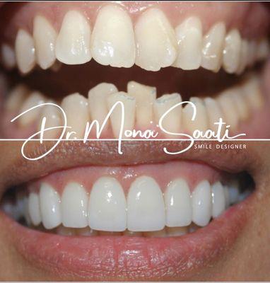 Teeth straightening with Invisalign and Porcelain Veneers to create the perfect proportion and symmetry