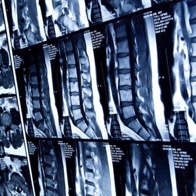 Spine MRI