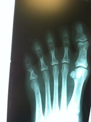 My broken foot