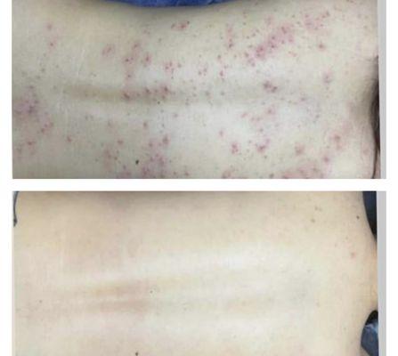 Clear and lighten back acne