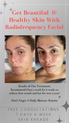 RF Facial