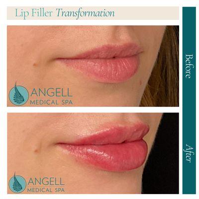 Lip FIller Juvederm , balance & natural results