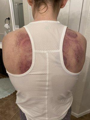 Back photo after cupping treatment