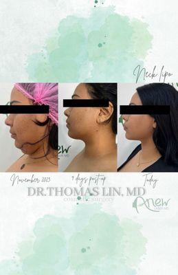 Chin liposuction with Renuvion