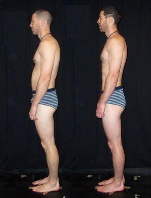 Before and After Rolfing