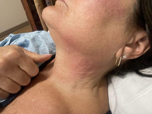 Hives on neck post day 5 of procedure.