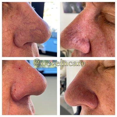 Nasal spider veins treated immediate results.