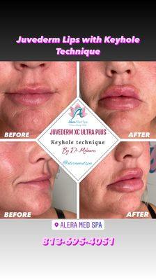 Keyhole technique using Juvederm