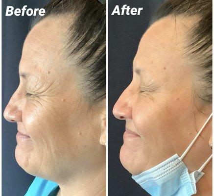 Results from Xeomin injections!