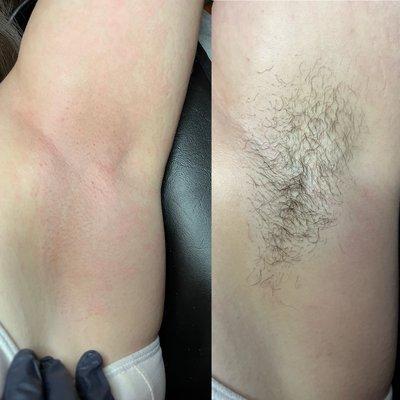 Underarm Wax * Before and After