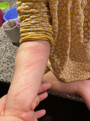 Our daughter's arm after a day at BlueBird