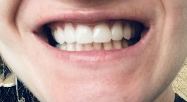 My camera phone is subpar but the dental work is fantastic shading and shape for what I wanted.