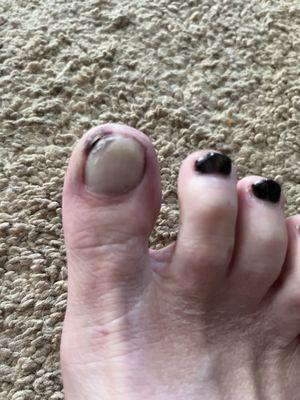 Infected toe