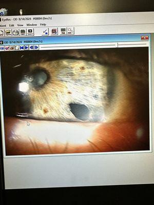 Dr. Prendaville put this large hole in my left eye which required surgery by another eye surgeon to fix.