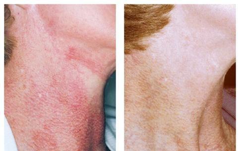 Vbeam Pulsed Dye Laser has been the gold standard in the treatment of vascular lesions, acne, psoriasis and wrinkle reduction...