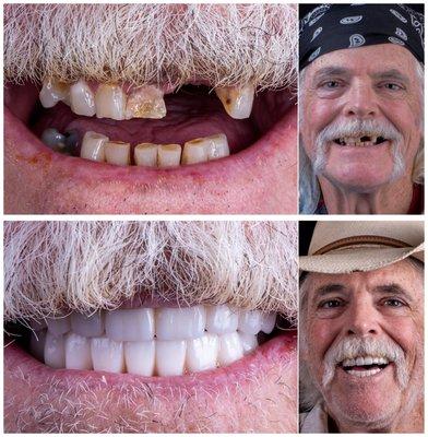 Before and after, Full Upper and lower dental implant makeover with Zirconia implant bridge