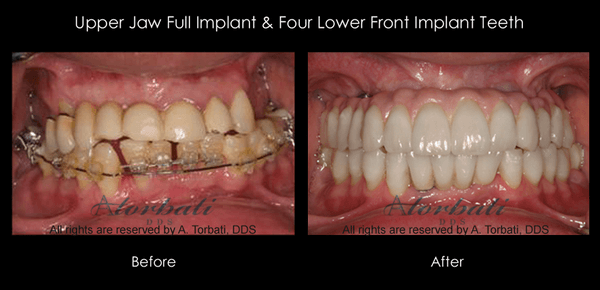 Full Upper & Lower Implant Rehabilitation