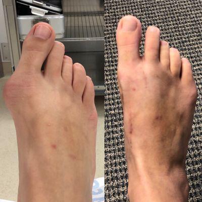 Bunion Transformation