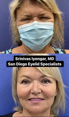 Amazing result from blepharoplasty by Dr. Srinivas Iyengar