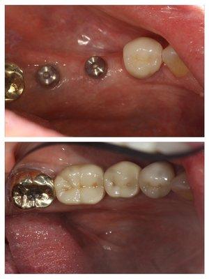 2 implants with crowns