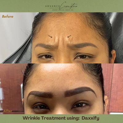 Fine line and wrinkles treatment! $7/unit