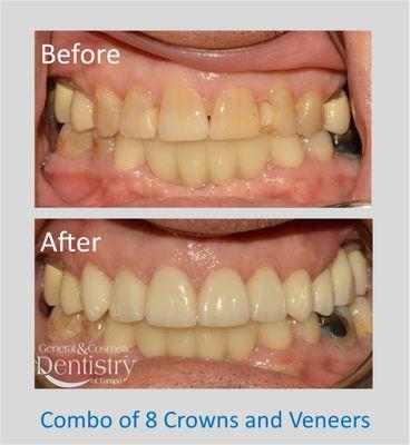 A Beautiful Smile builds Confidence! Call today for a consultation with Dr. MIchael Diez