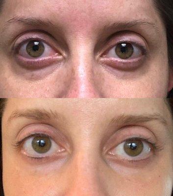 1/2 syringe of under eye filler