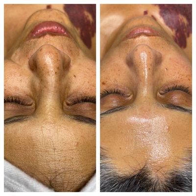 Beautiful before and after 90 minute facial