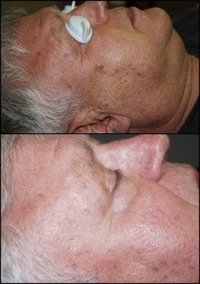 age spot removal after just 1 treatment.