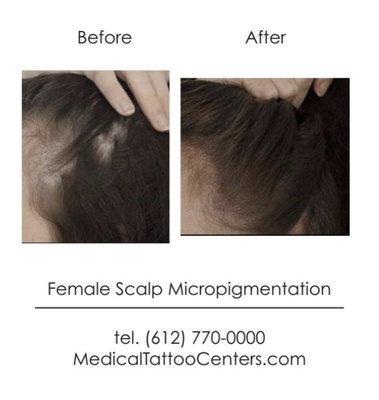 Men aren't the only ones with hair thinning issues. Females can have them too!