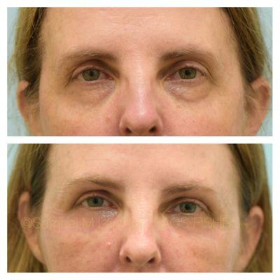 This 49-year-old female is shown before and two weeks after incisionless surgery: fat transfer to the lower eyelids and no-incision eyebag