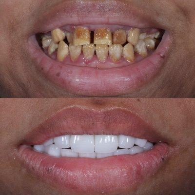 Porcelain veneers before/after!