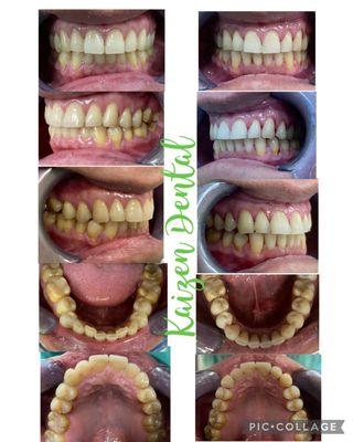 Small changes, big improvement. 18 months treatment to correct crossbite, eliminate crowding, faciliate oral hygiene, reduce gum recession.