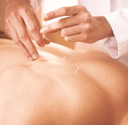 Acupuncture, rooted in traditional Chinese medicine, aims to restore and maintain harmony within the body by balancing its energy, or Qi.